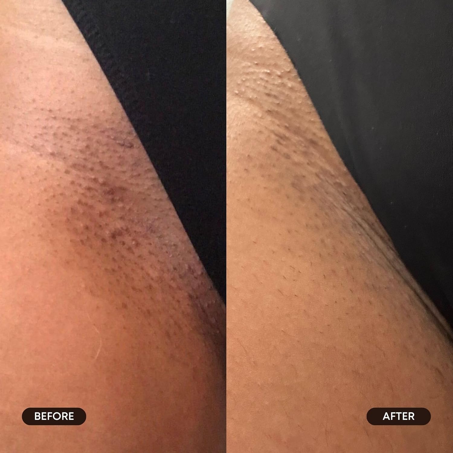 Bushbalm Exfoliating Ingrown Hair Pads - Enhanced with BHA & AHA for Underarm + Bikini Area - Daily Use to Soothe Ingrown Hairs & Razor Bumps - TXA for Dark Spots - Radiant Reset 30 Large Pads - Image 6
